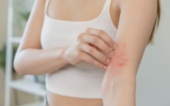 Obat Panu, Kadas, dan Kurap Paling Ampuh Dijamin Cepat Sembuh