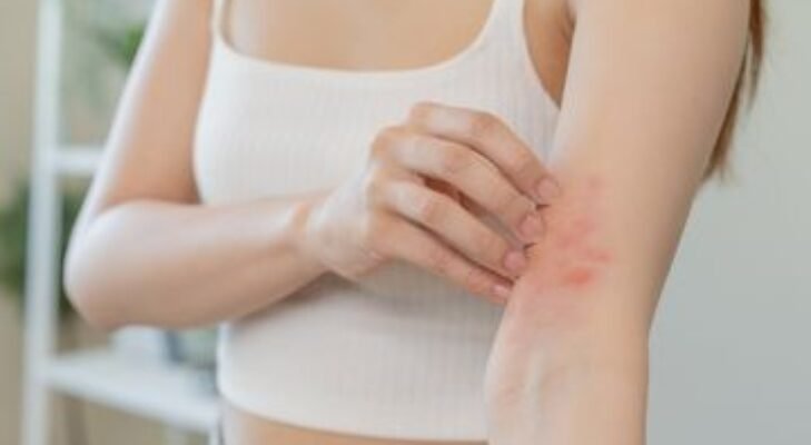 Obat Panu, Kadas, dan Kurap Paling Ampuh Dijamin Cepat Sembuh